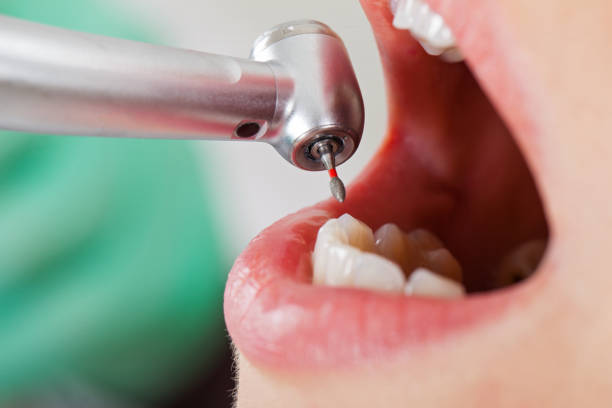 Best Dental Abscess Treatment in Orange Blossom, CA